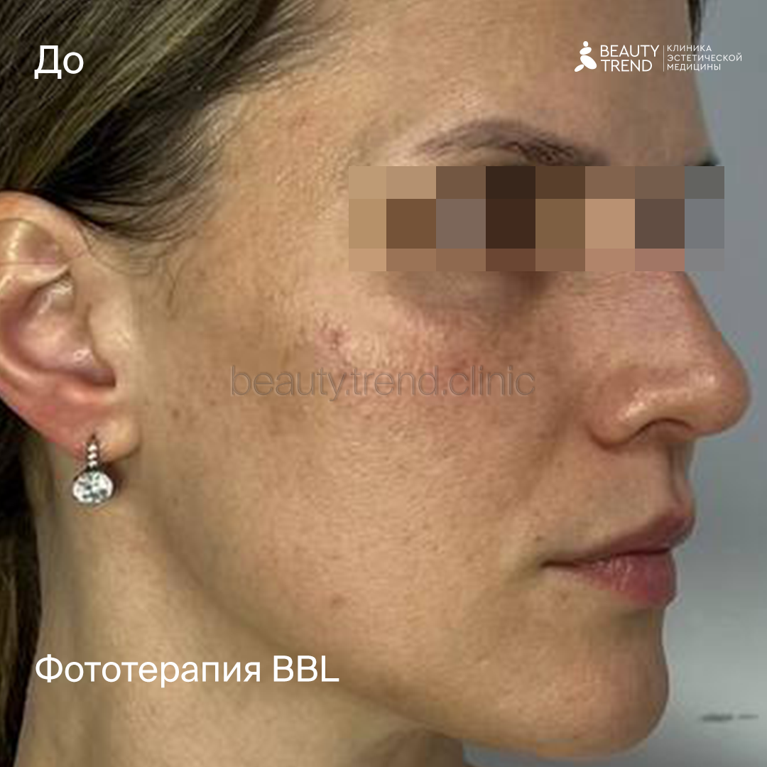 Фототерапия BBL - до 1